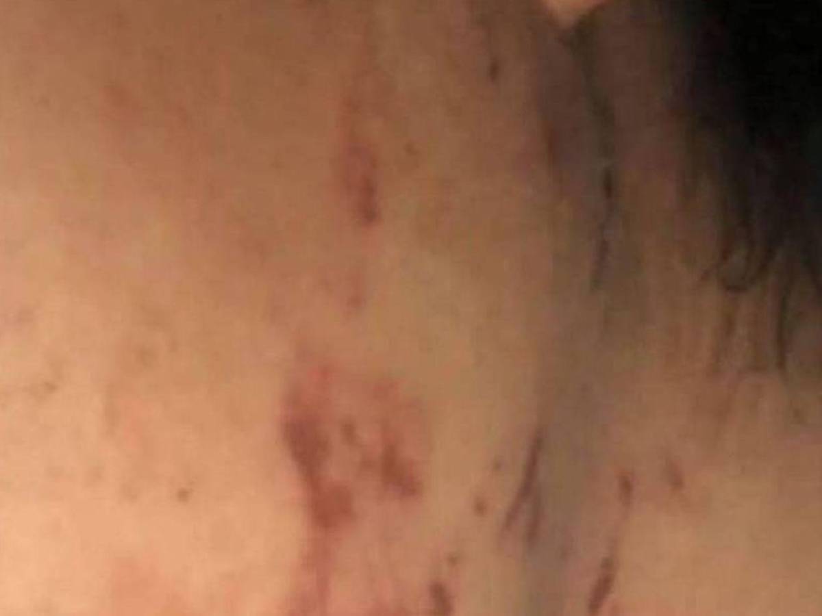 Como si fuera un pitbull: Hombre ataca a mordidas a su pareja en Olancho