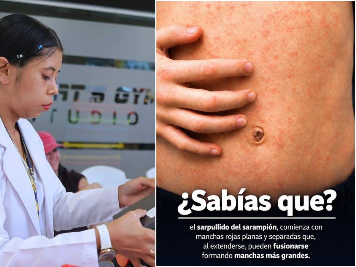 Cinco señales de alerta ante brote de sarampión en el sector Cofradía