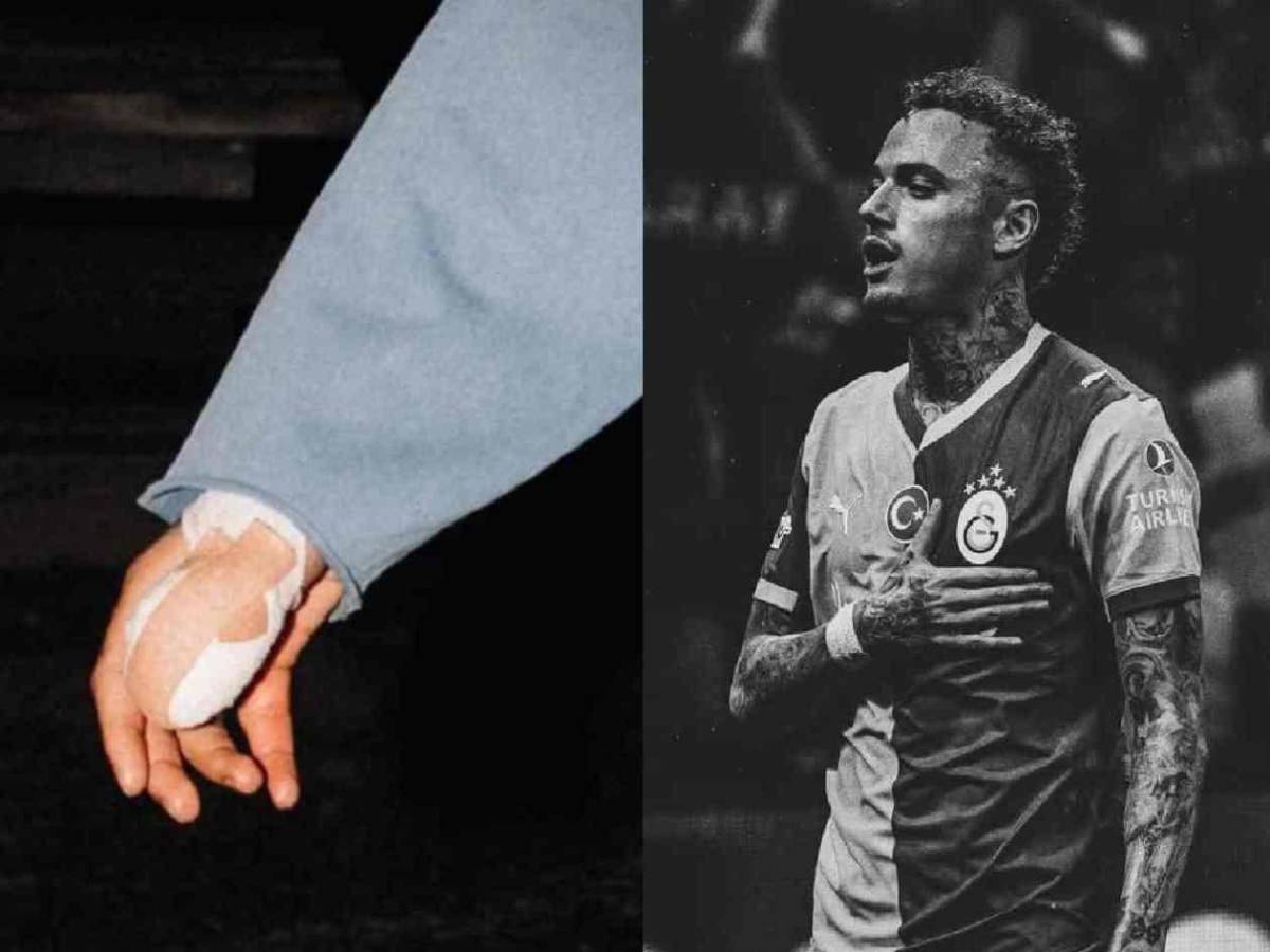 Impactante relato tras lesión en Champions: “Mi pulgar quedó colgando”