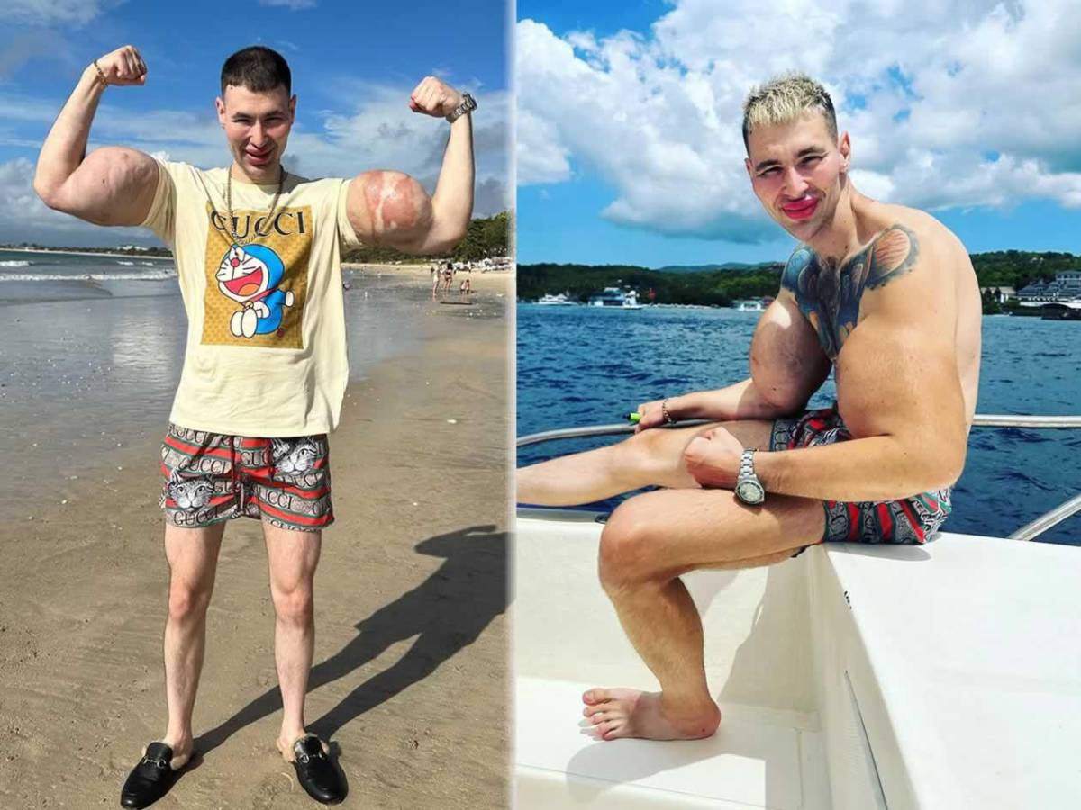 Deportista 'Popeye ruso' hace dramática confesión: podría perder los dos brazos