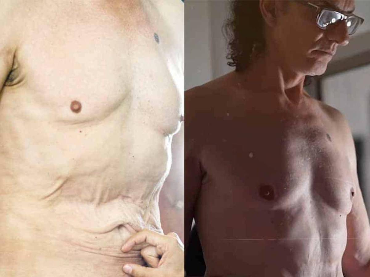 Antes y después del actor de Pedro el Escamoso, Miguel Varoni tras cirugía