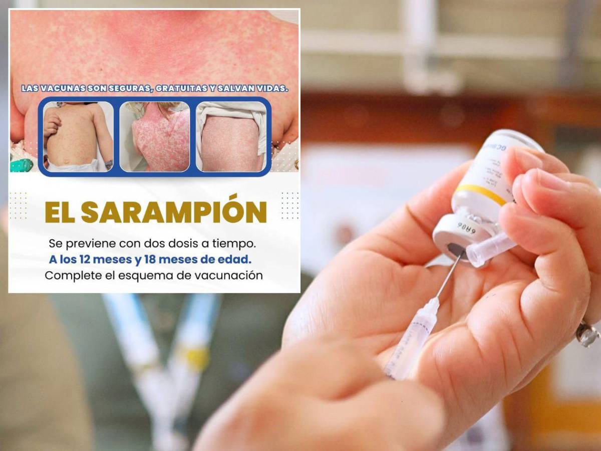 Cinco señales de alerta ante brote de sarampión en el sector Cofradía