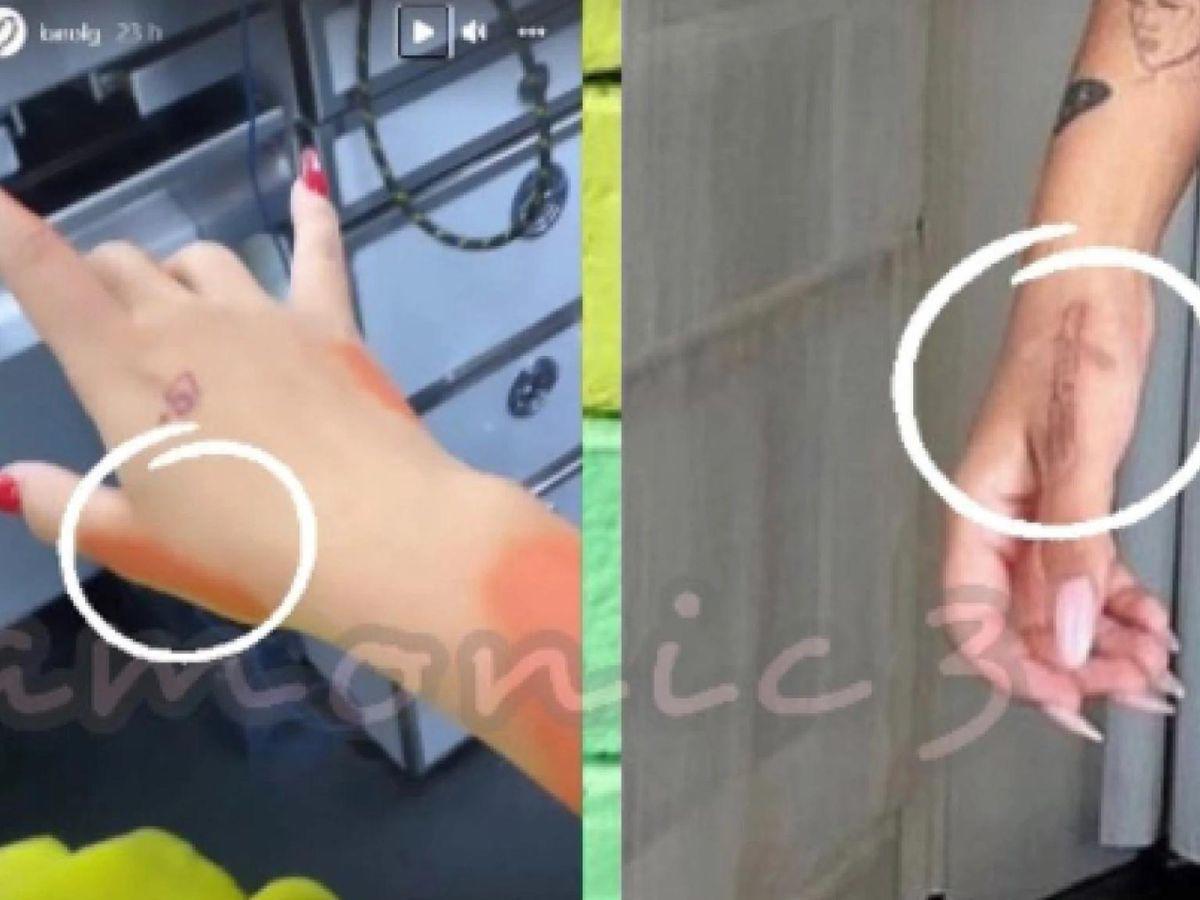 Fotografías del tatuaje removido de Karol G.