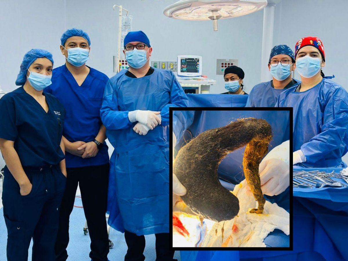 Médicos extraen bola de pelo de estómago de una joven