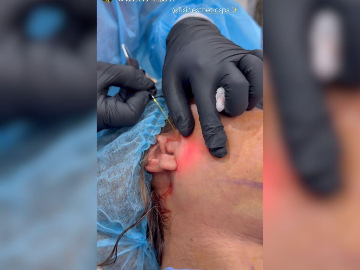 Alejandra Rubio se somete a nuevo procedimiento estético