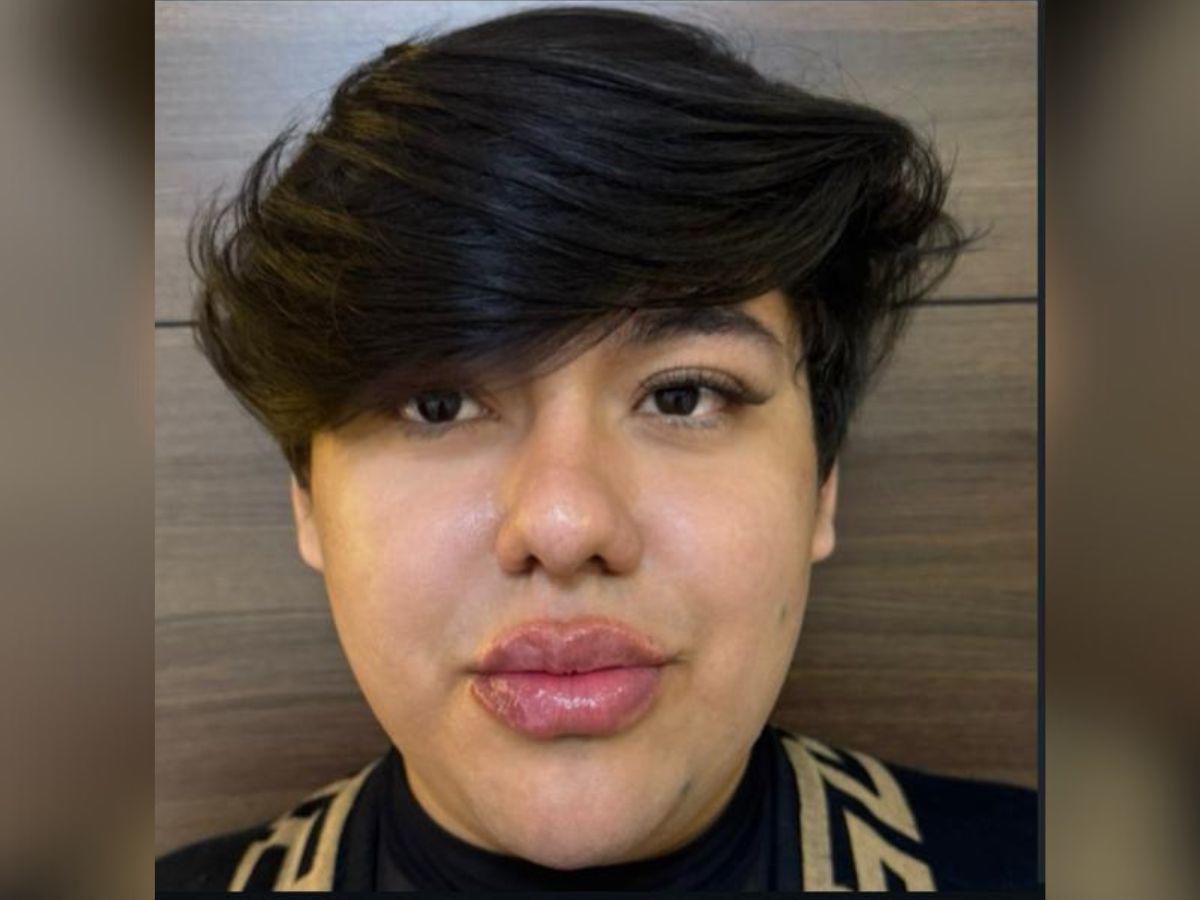 Antonio Sandrez presume sus nuevos labios: “Atáquense y admiren