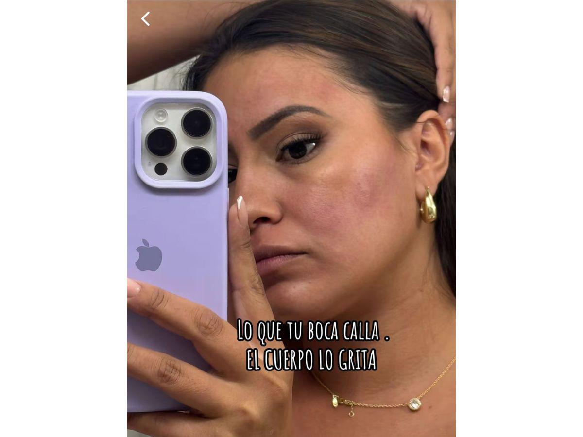 Alejandra Rubio reaparece con su rostro inflamado: ¿qué le pasó?