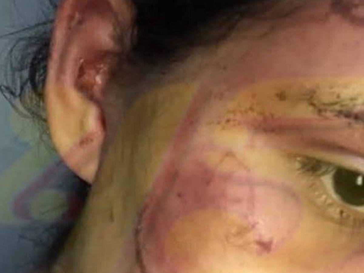 Como si fuera un pitbull: Hombre ataca a mordidas a su pareja en Olancho