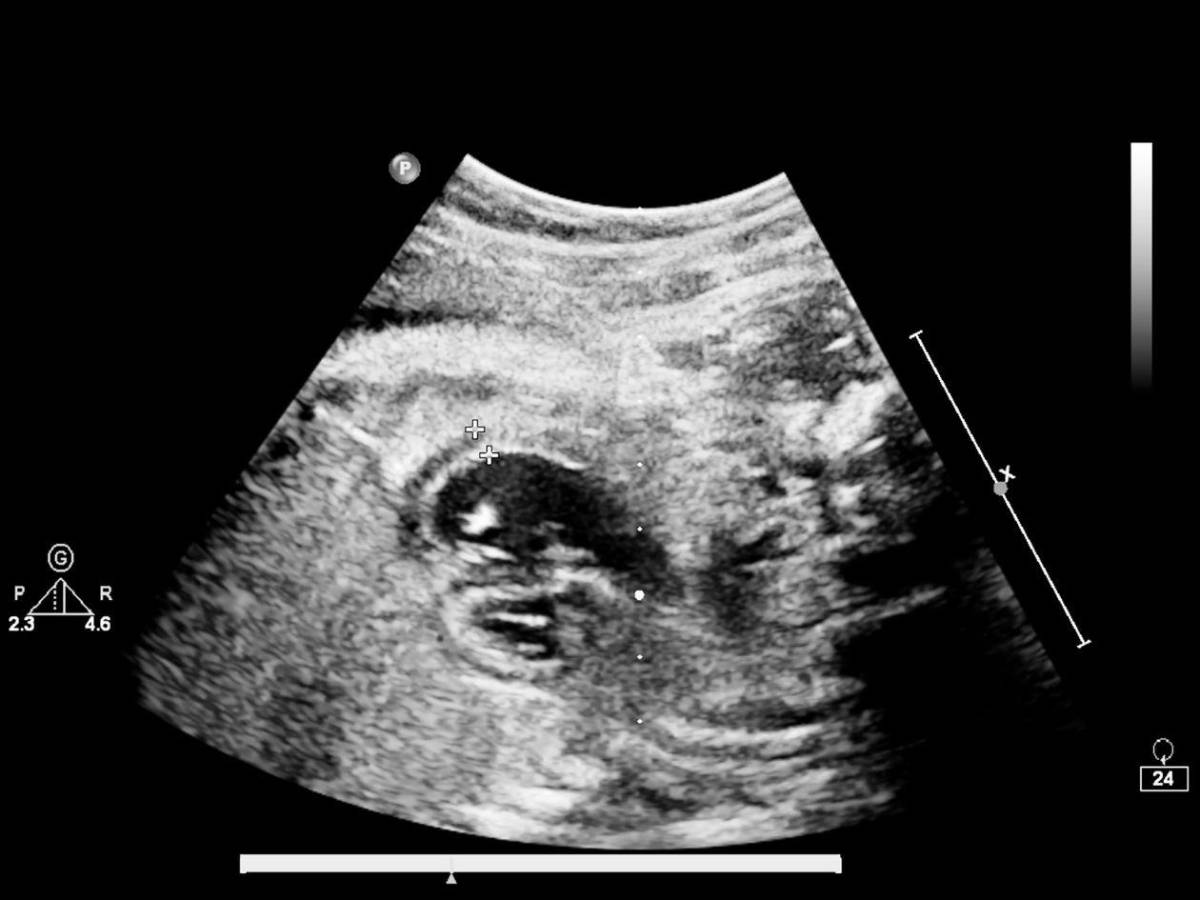 ¿Qué es el tamizaje neonatal? La prueba que puede salvar la vida de su recién nacido