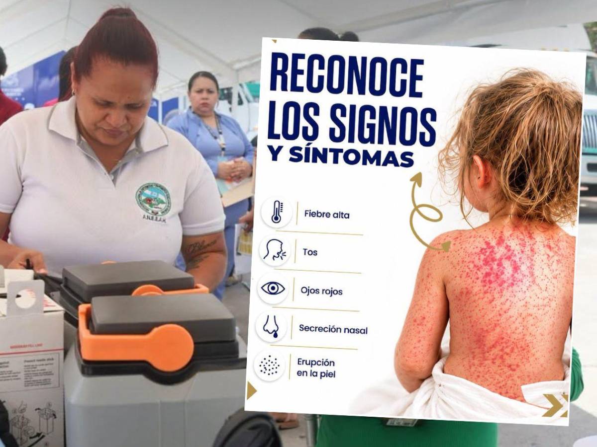 Cinco señales de alerta ante brote de sarampión en el sector Cofradía