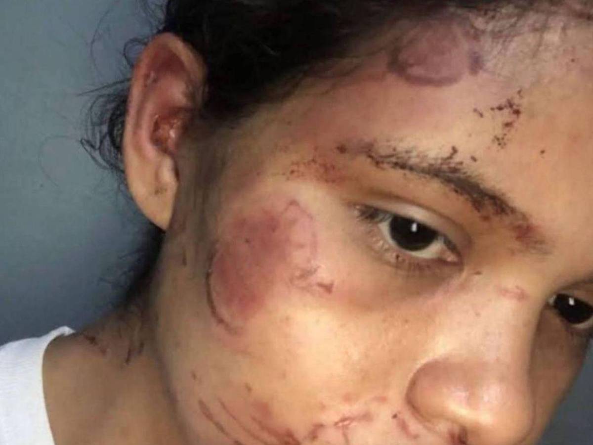 Amenazó con matar a mi mamá o mi papá: Dayani tras ser atacada a mordidas por su expareja