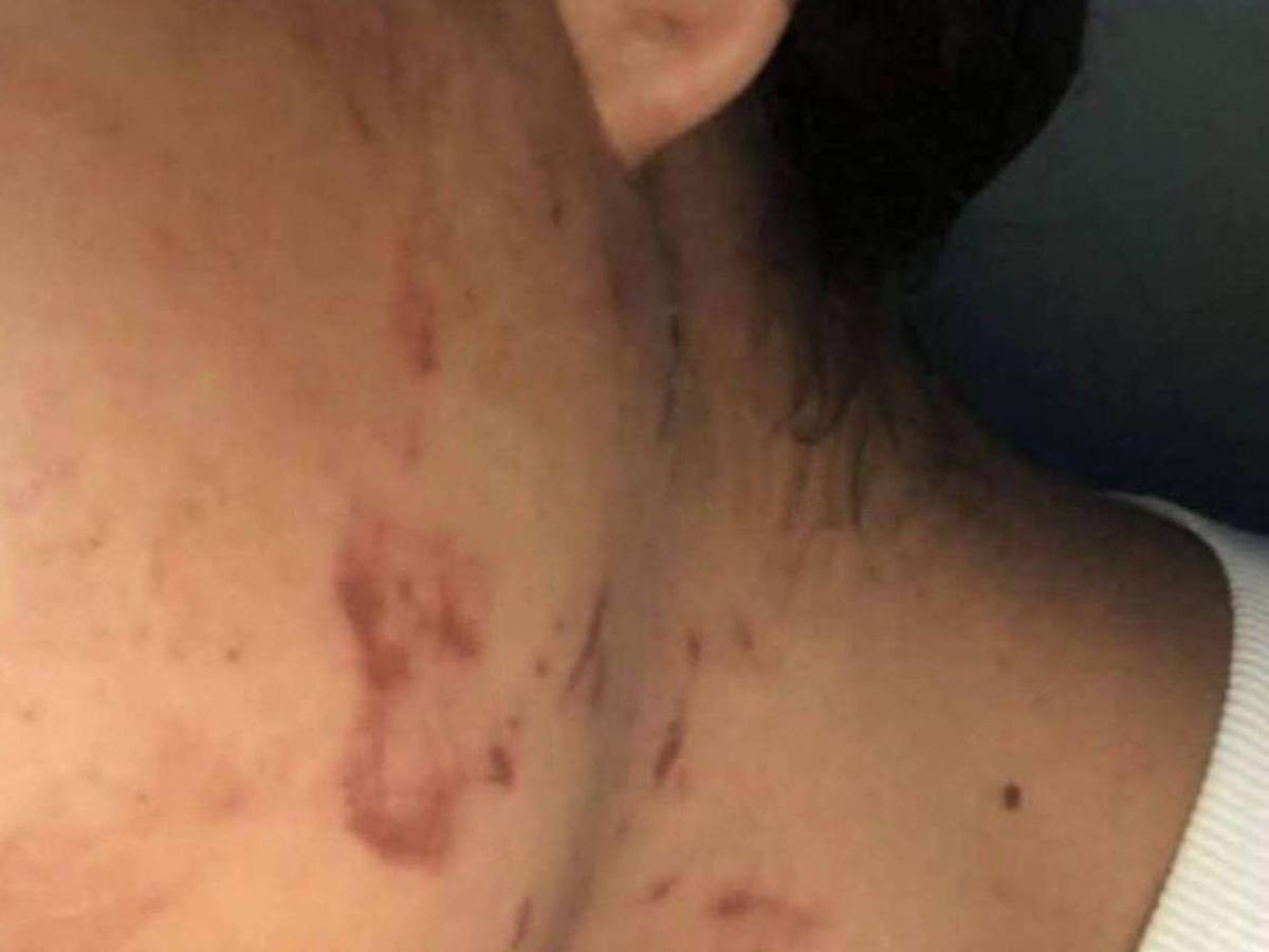 Amenazó con matar a mi mamá o mi papá: Dayani tras ser atacada a mordidas por su expareja