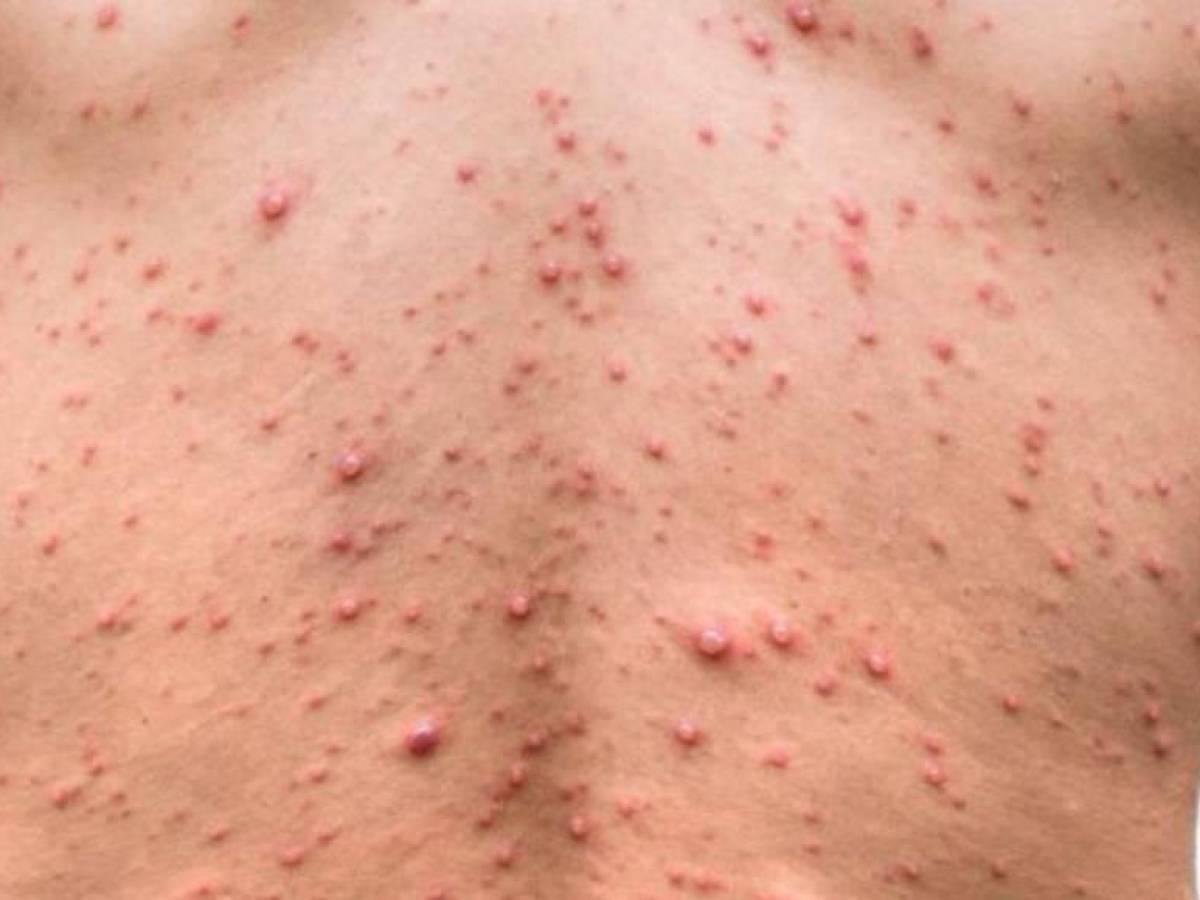 Un migrante, cuarto caso de viruela del mono en Honduras