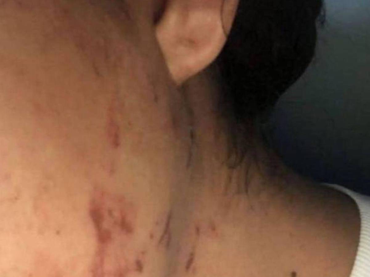 Como si fuera un pitbull: Hombre ataca a mordidas a su pareja en Olancho