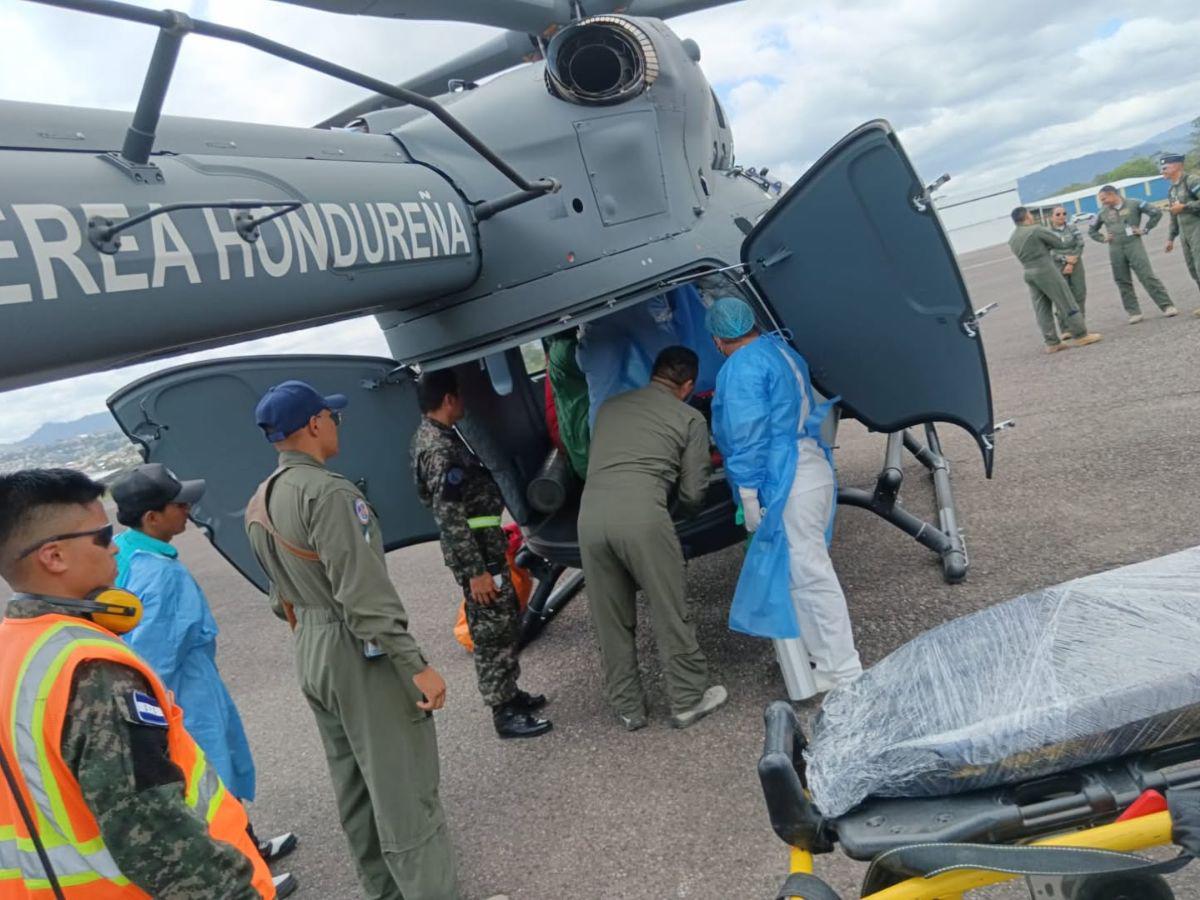 Menor quemada en explosión de pólvora en Copán es trasladada a Tegucigalpa