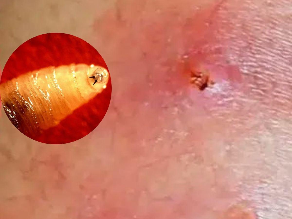 Nicaragua detecta dos casos del gusano barrenador en humanos