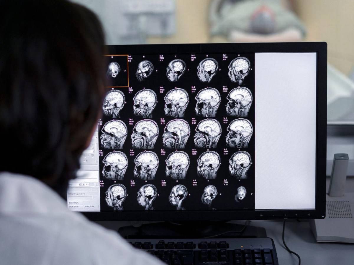 ¿Cómo reconocer a tiempo un derrame cerebral?