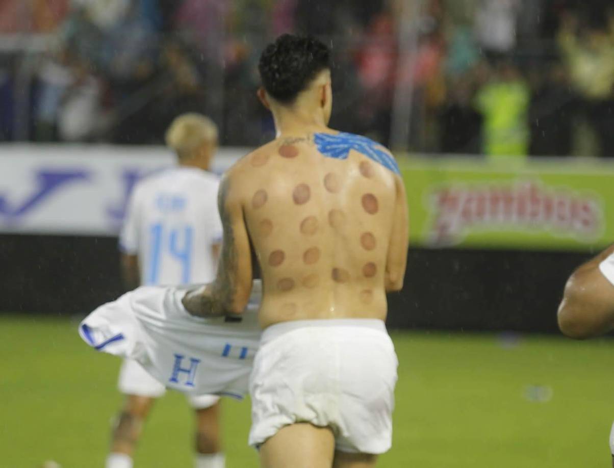 La curiosa imagen de Luis Palma, la figura de Honduras ante México con su doblete. Es un técnica que sirve para aliviar los dolores musculares y mejorar la circulación sanguínea.