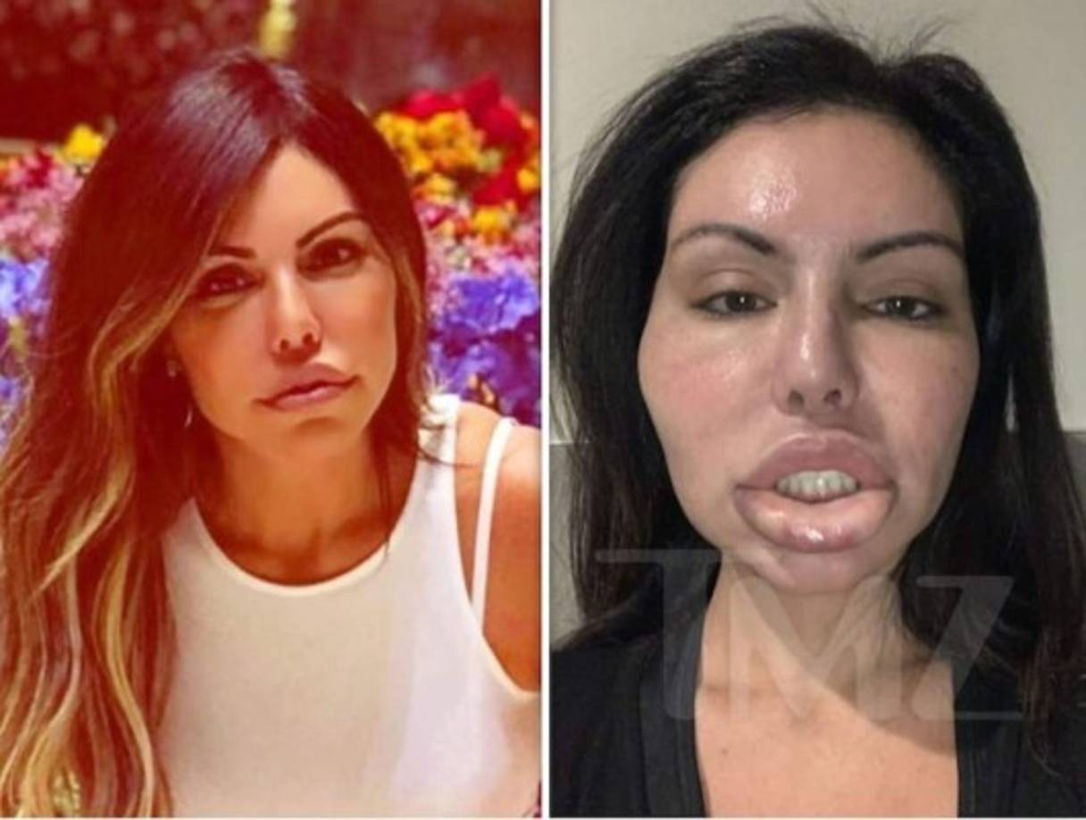 Liziane parece llevar una vida con muchos riesgos. Según TMZ en 2018 la modelo fue puesta en coma inducido después que una liposucción en Turquía tuviera complicaciones.<br/><br/>Este 2019 el mismo portal compartió las fotos del después de la maniquí cuando unas inyecciones de bótox salieran mal y su cara se hinchara terriblemente.<br/>