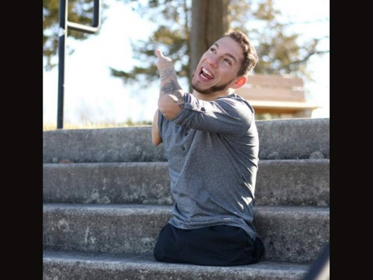 Nick Santonastasso es un joven que nació con una de las enfermedades más extrañas del mundo.