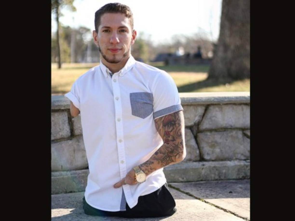 El Síndrome de Hanhart, su cuerpo no desarrolla órganos y extremedidades.