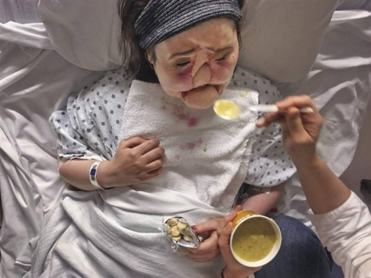 A finales de 2016, Katie fue seleccionada para una lista de espera para un trasplante de rostro. Fue preparada física y psicológicamente para este proceso que literalmente cambiaría su vida.