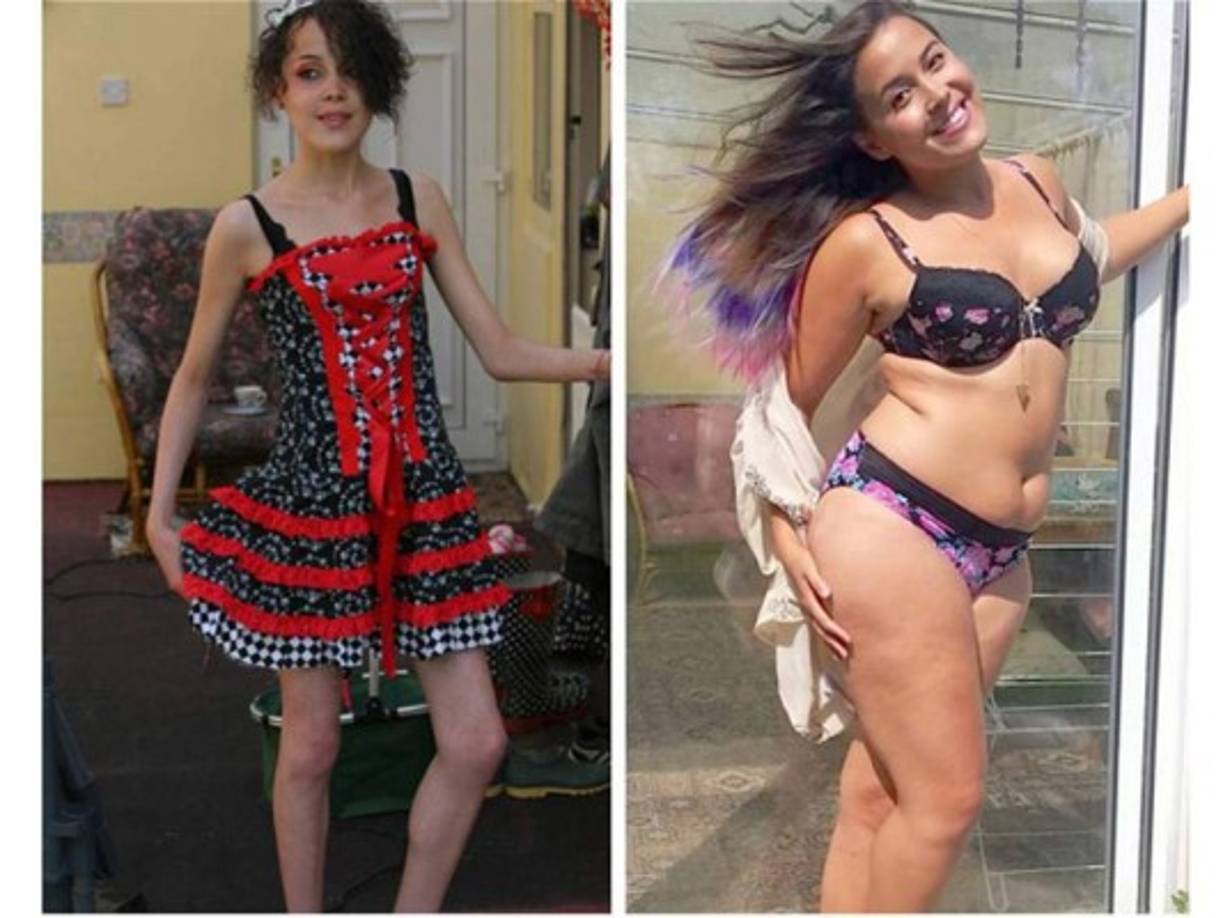 Megan Jayne comenzó a sufrir por problemas de imagen con su cuerpo desde los cinco años. A los 14 fue diagnosticada con anorexia, por lo que se internó en una institución mental para jóvenes antes de ser hospitalizada.
