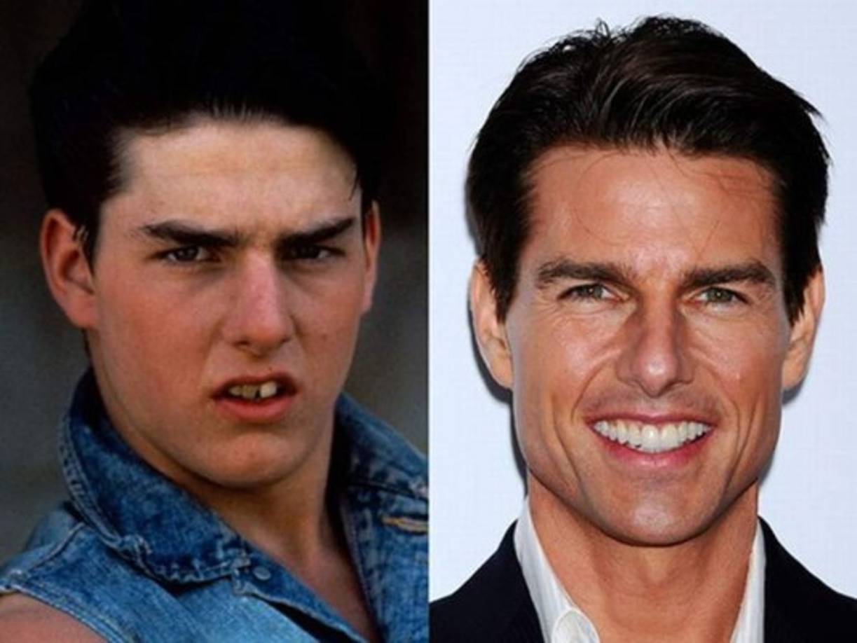 Tom Cruise. <br/>Sin duda el actor es uno de lo más elogiados en la industria el cine tanto por sus interpretaciones como por su atractivo físico, tal vez eso no hubiera sido posible si no se hubiera retocado sus dientes, ya que decidió cambiarlos totalmente y dejar atrás aquellos dientes torcidos y amarillos para tener una sonrisa impecable.