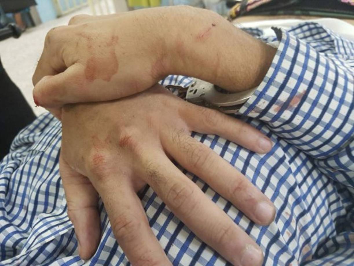 Momento en el que era atendido uno de los heridos en el Hospital Escuela Universitario (HEU).