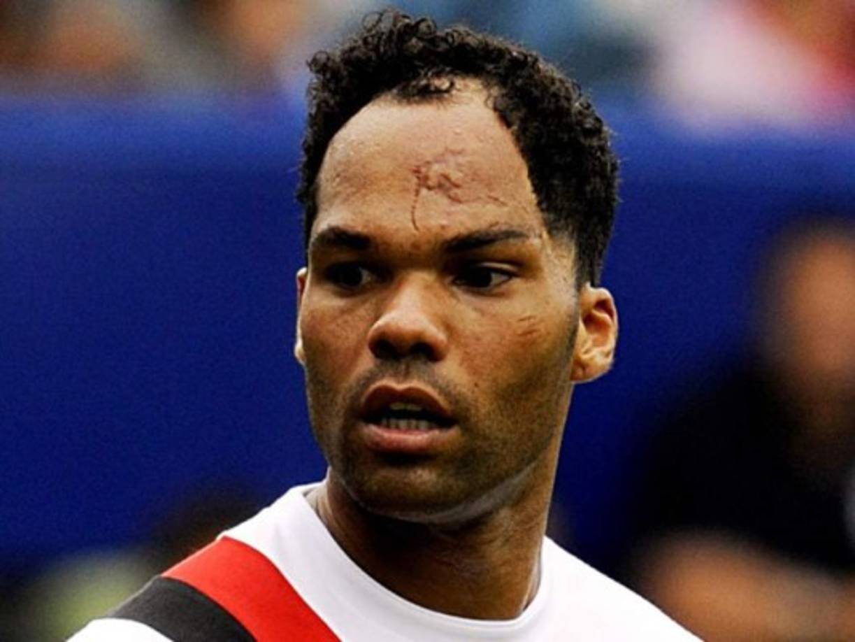 Joleon Lescott. El central del West Bromwich tiene esa cicatriz en la frente, fue atropellado por un coche cuando tenía 5 años. Pasó muchos meses ingresado en el hospital y por múltiples operaciones pero cumplió su sueño: ser futbolista.