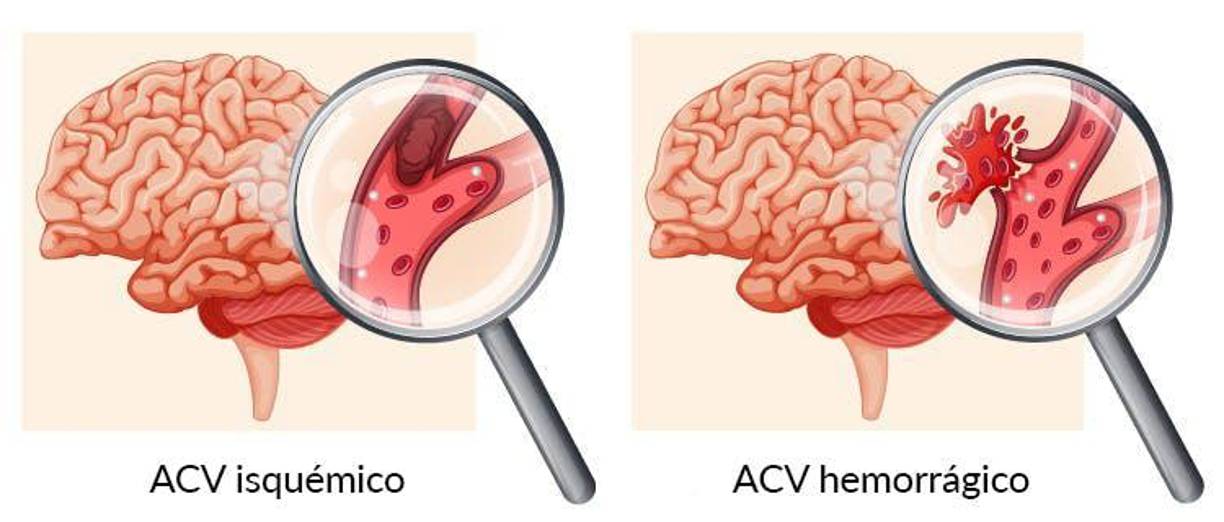 Hay dos tipos principales de accidente cerebrovascular: accidente cerebrovascular isquémico y accidente cerebrovascular hemorrágico