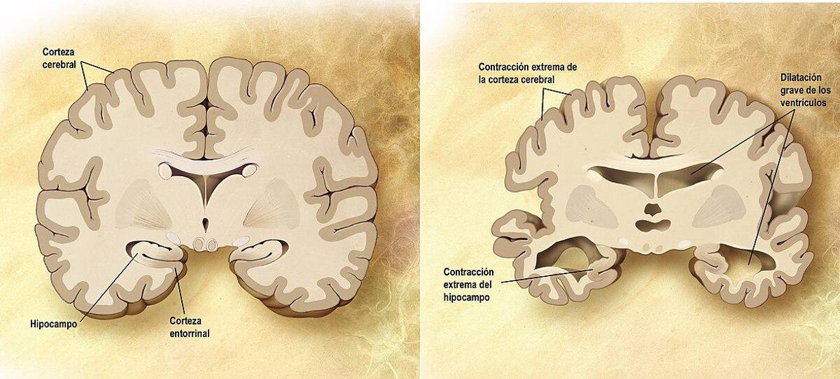 Se conocen factores genéticos que aumentan el riesgo de desarrollar la enfermedad, como por ejemplo tener más alelos del gen de la apolipoproteína E (APOE4). Los factores genéticos que tienen una relación más directa con la enfermedad son los casos de inicio temprano (antes de los 65 años) que representan menos del 10 % de todas las personas con Alzheimer.