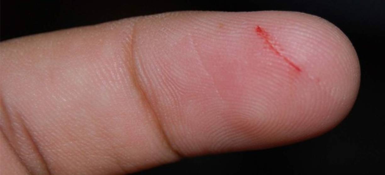 Sanación lenta de lesiones y cortaduras.