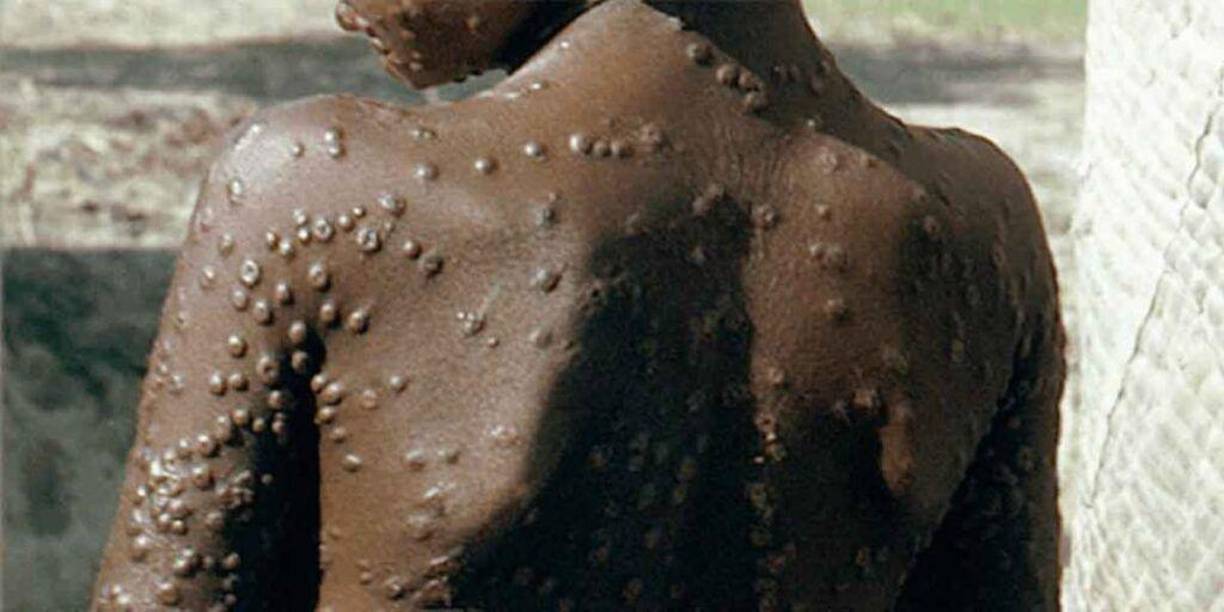 Es vital evitar el contacto cercano con personas que presenten síntomas de viruela del mono. No toques las lesiones ni los fluidos corporales de personas infectadas y busca atención médica si sospechas una infección.