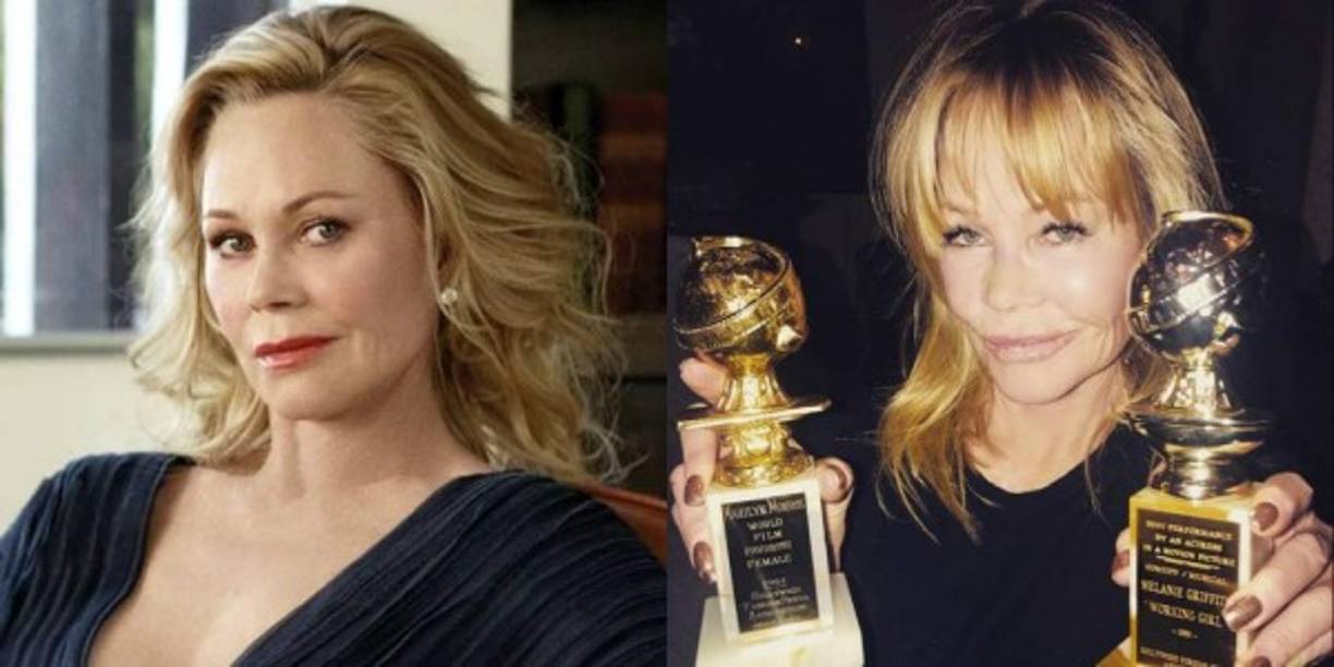 La doctora Mar Campos añade que también hay exceso de toxina botulínica en la parte superior del rostro, por lo que cuando sonríe no hay arrugas arriba de su cara, en contraste con la parte inferior, en donde se ven arrugas.<br/><br/>'Ha perdido totalmente la expresión y es otra persona, ya que se sobre-trabajó la parte superior de la cara y se olvidó la parte de abajo', señaló.<br/>