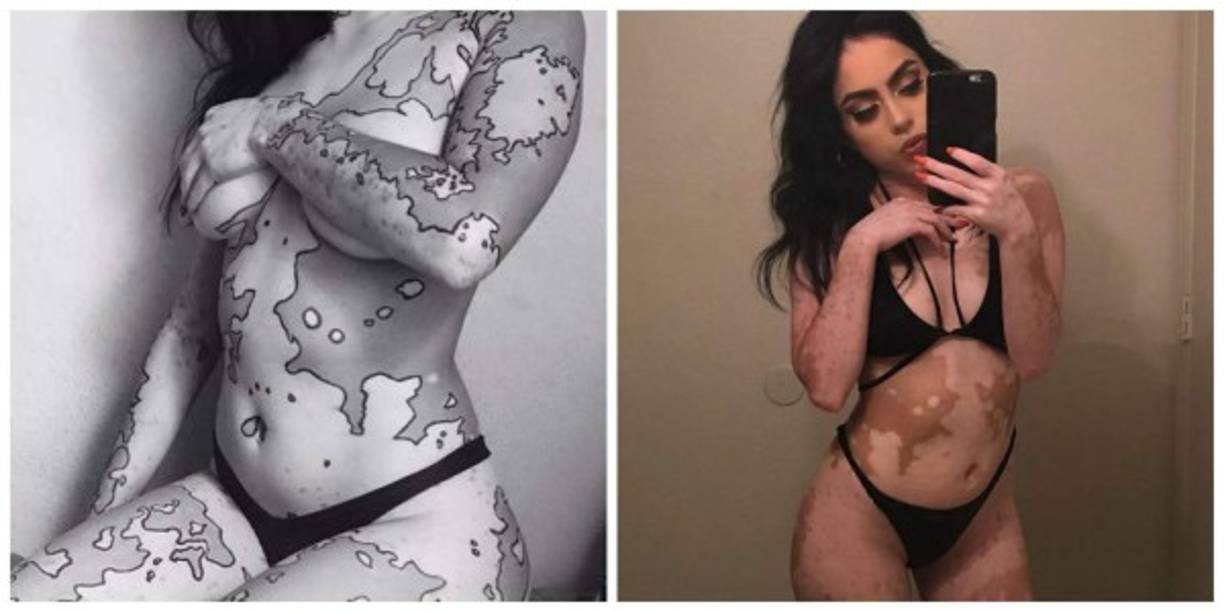 A la edad de 12 años, Soto se dio cuenta que padecía de vitíligo al ver como un pequeño lunar en su cuello se extendió al punto de invadir el 75 por ciento de su cuerpo, creando desde entonces una serie de complejos al soportar comentarios despectivos. Fotos:Instagram radiantbambi