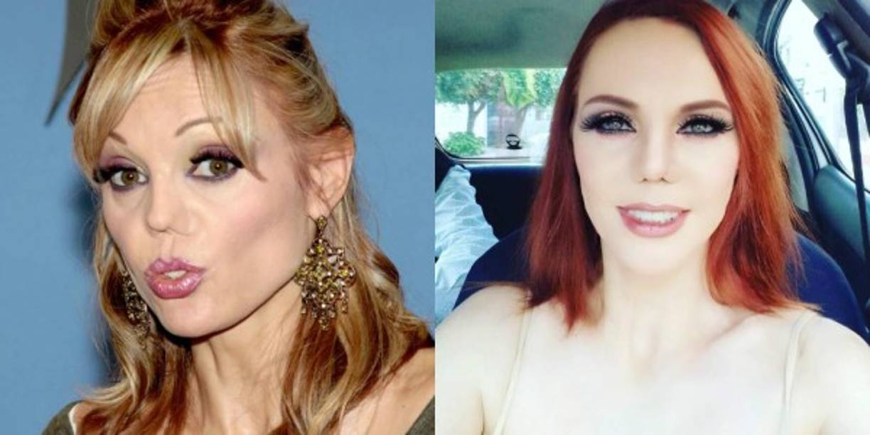 Después de las últimas tres cirugías reconstructivas, Campuzano ha vuelto a tener una nariz normal. <br/>