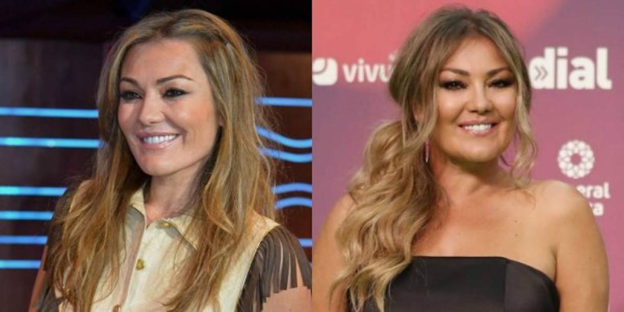 Según varios expertos en cirugía estética, la cantante pudo haberse sometido a un tratamiento llamado Lipofilling, que ayuda a disminuir las arrugas.