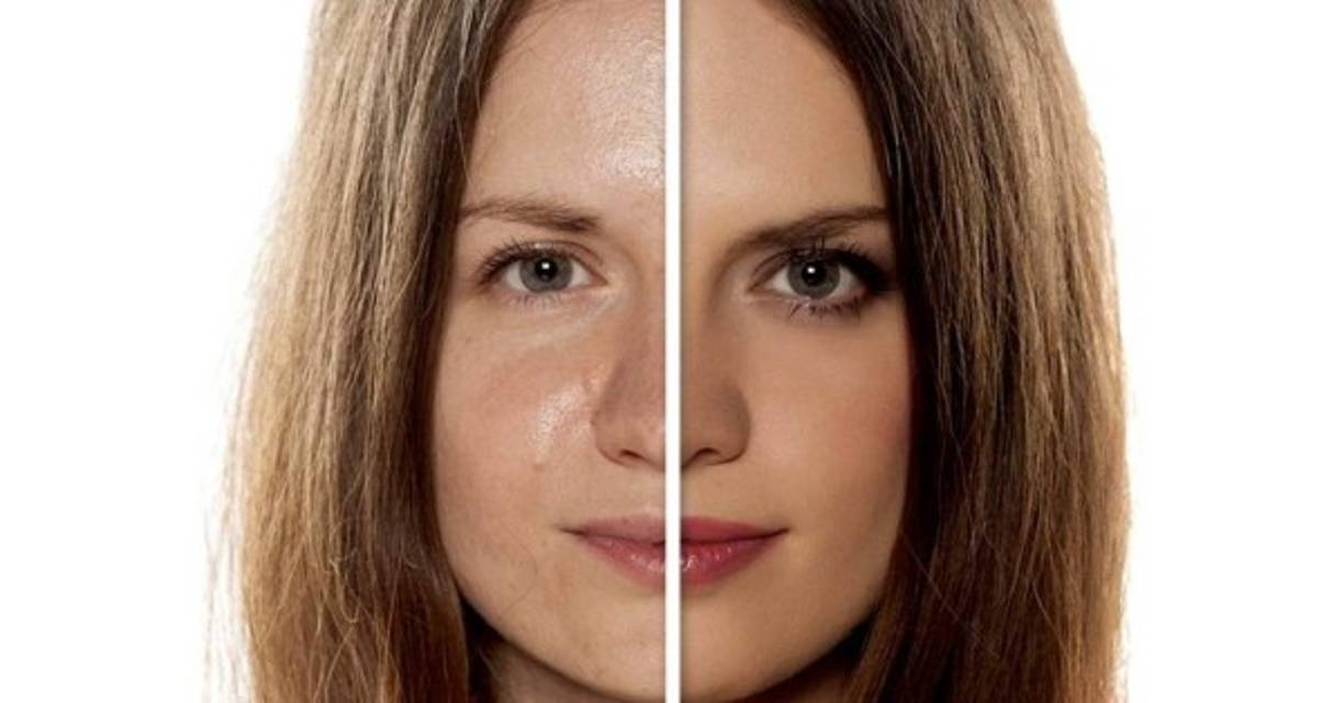 5. Para la piel muy aceitosa, las cremas humectantes no son necesarias; la piel ya hace su trabajo para evitar la resequedad.