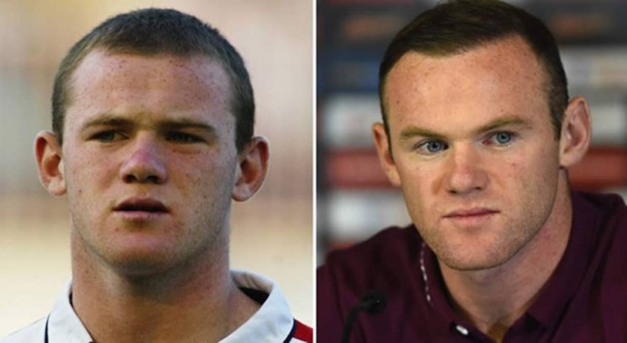 Wayne Rooney se hizo un implante de cabello porque aseguraba que a los 25 años iba a perderlo todo. Se dice que también se hizo un pequeño arreglo en la nariz.