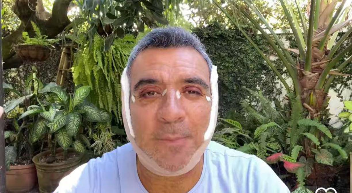 “No se espanten, soy yo, lo que pasa es que pareciera que me atropelló un camión, pero no, no es así. Lo que tengo yo en mi rostro es el producto de una operación estética, una cirugía plástica, que me acabo de hacer aprovechando que estaba aquí en Guatemala por el cumpleaños y deceso de mi querida madre”, comenzó compartiendo el presentador.
