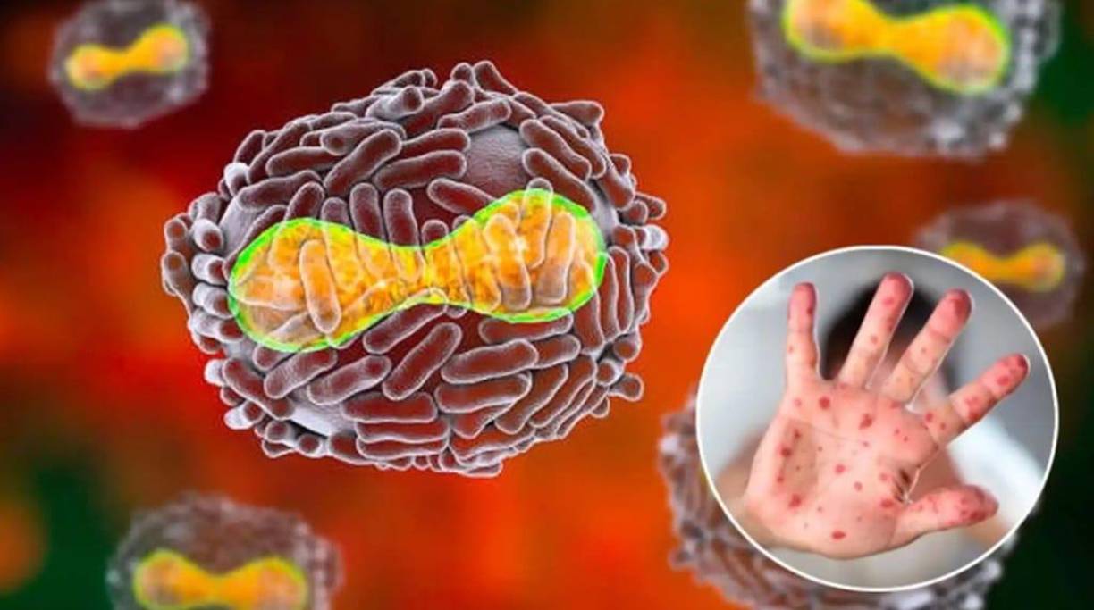 La viruela del mono se descubrió en 1958 cuando ocurrieron dos brotes de una enfermedad similar a la viruela en colonias de monos mantenidos para investigación. No obstante, la fuente de la enfermedad sigue siendo desconocida. Sin embargo, los roedores africanos y los primates no humanos (como los monos) pueden albergar el virus e infectar a las personas.