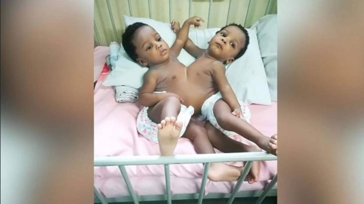 En la cirugía también participaron especialistas en anestesia, cuidados intensivos e imágenes cerebrales. En imagen el caso de dos siamesas nigerianas que fueron separadas con éxito por una unión entre el pecho y el estómago. Fotografía: Hospital de Abuja, Nigeria.