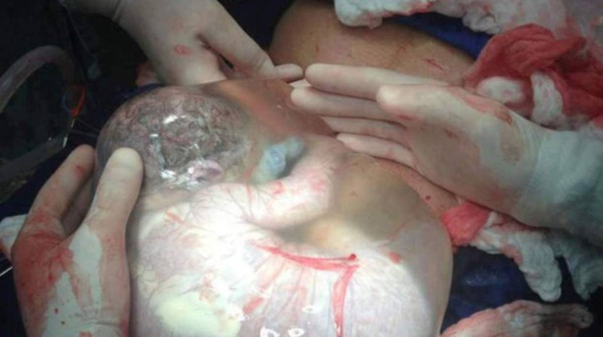 Un increíble video de un bebé que nace dentro de la bolsa amniótica se ha vuelto viral y comprueba una vez más el milagro de la vida. El maravilloso momento fue grabado por una enfermera de la Santa Casa de Misericordia de Barretos, en Sao Paulo, Brasil. Gih Flor de Lis publicó el video del momento en su perfil de Facebook en el que se puede ver cómo el pequeño cree que aún está dentro de su madre, protegido por el líquido amniótico. Esta bolsa es una delgada membrana pero resistente llena de líquido y que ayuda a mantener al bebé cálido y seguro de los golpes durante el embarazo. Cuando se rompe, es lo que típicamente se conoce como 'romper aguas'.