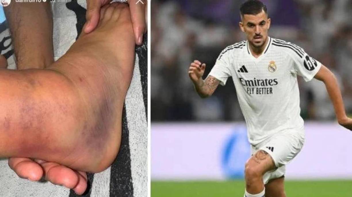 Uno de ellos es Dani Ceballos, que se lesionó contra el Real Betis. Una dura dolencia de tobillo lo tendrá dos meses de baja.