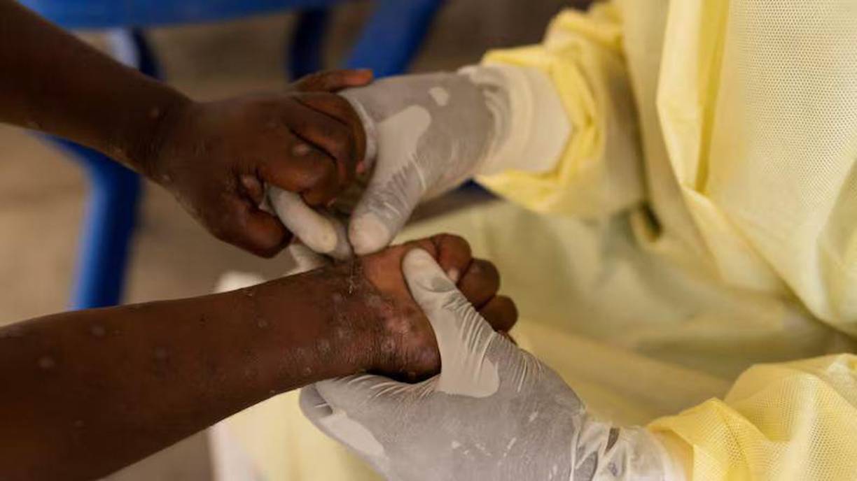 Fuentes del Centro para el Control y Prevención de Enfermedades de África han indicado que casi el 70% de los casos en el Congo se presentan en niños menores de 15 años, quienes también representan el 85% de las muertes.