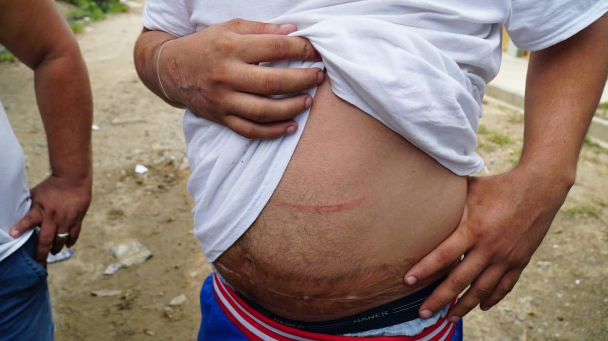 Además, pobladores también mostraron ante las cámaras pequeñas heridas que sufrieron durante el hecho. 