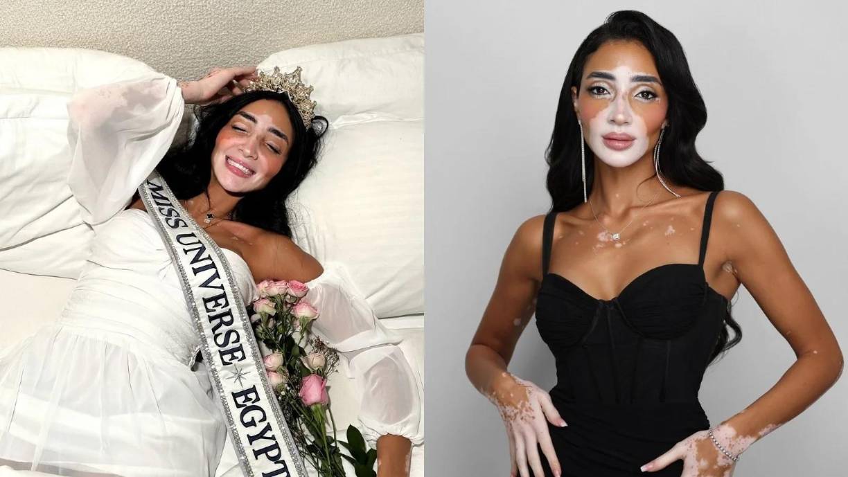 Miss Egipto, Logina Salah,<b> </b>presenta vitíligo en su piel, mientras que la representante de Sudáfrica, Mia le Roux, es sorda.