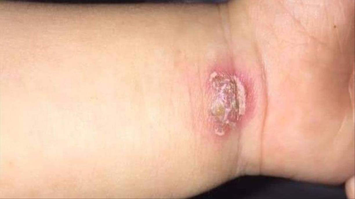 Las más comunes son la cutánea y la visceral. El tipo cutáneo causa llagas en la piel. Todos los casos son tratados en los centros de salud. 