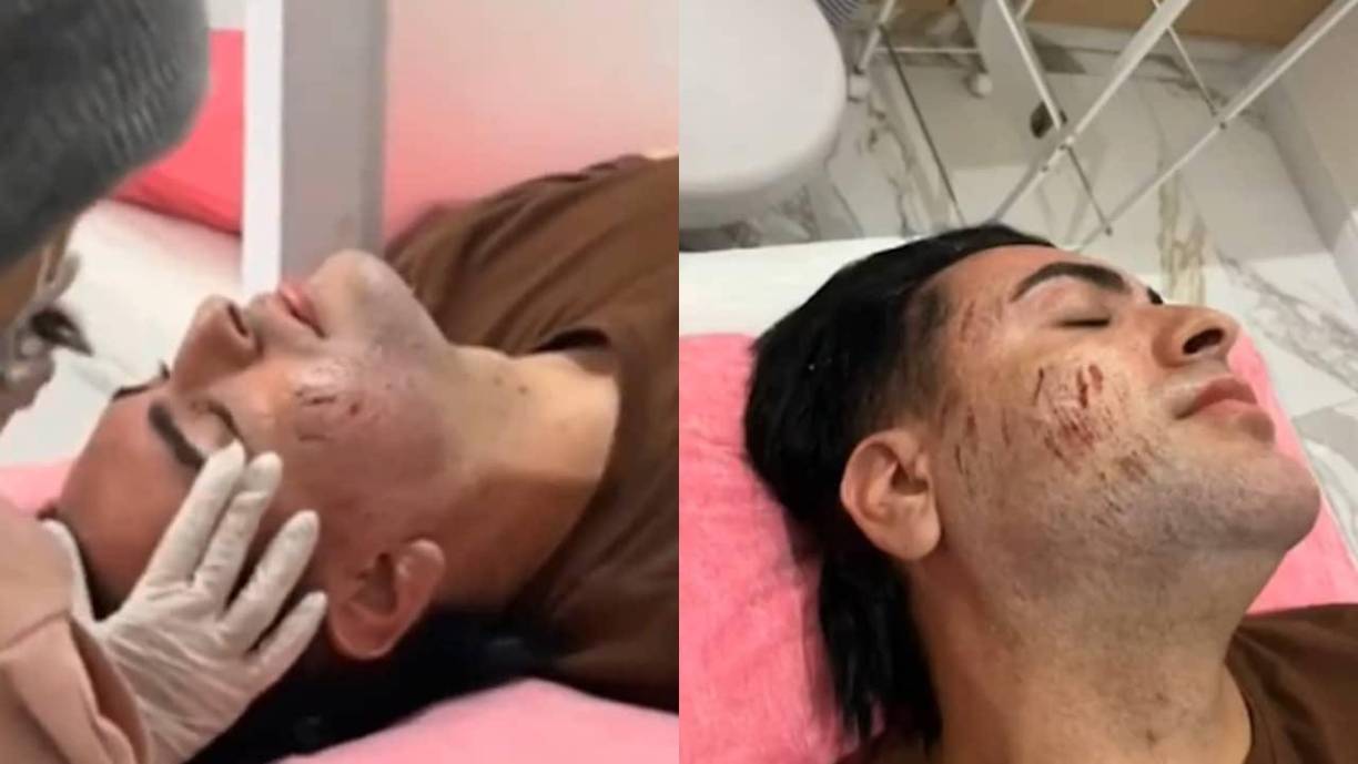 Comenzó a perder el conocimiento y, eventualmente, quedó desmayado en una de las camas de la clínica, donde finalmente dejó de reaccionar. El primer reporte médico citado por medios locales sugiere que la inhalación del producto pudo haber causado asfixia y un posterior paro cardíaco.